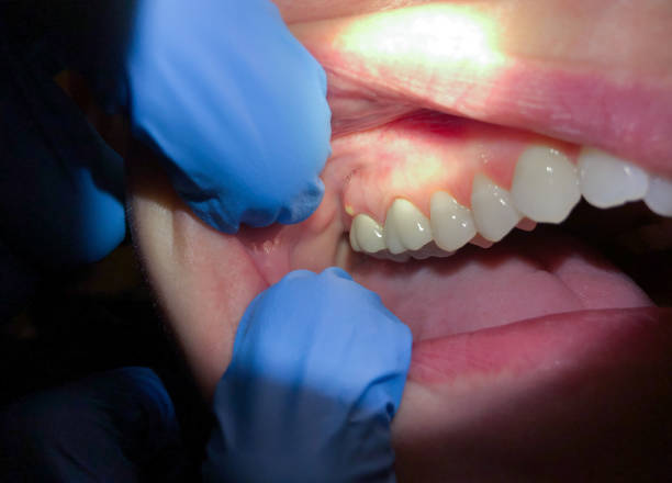 Best Dental Abscess Treatment in Edgewood, MD